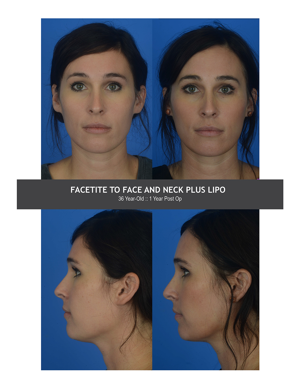 Facetite Before and After Photo by Dr. Caceres in St. Petersburg, FL Facetite Before and After Photo by Dr. Caceres in St. Petersburg, FL