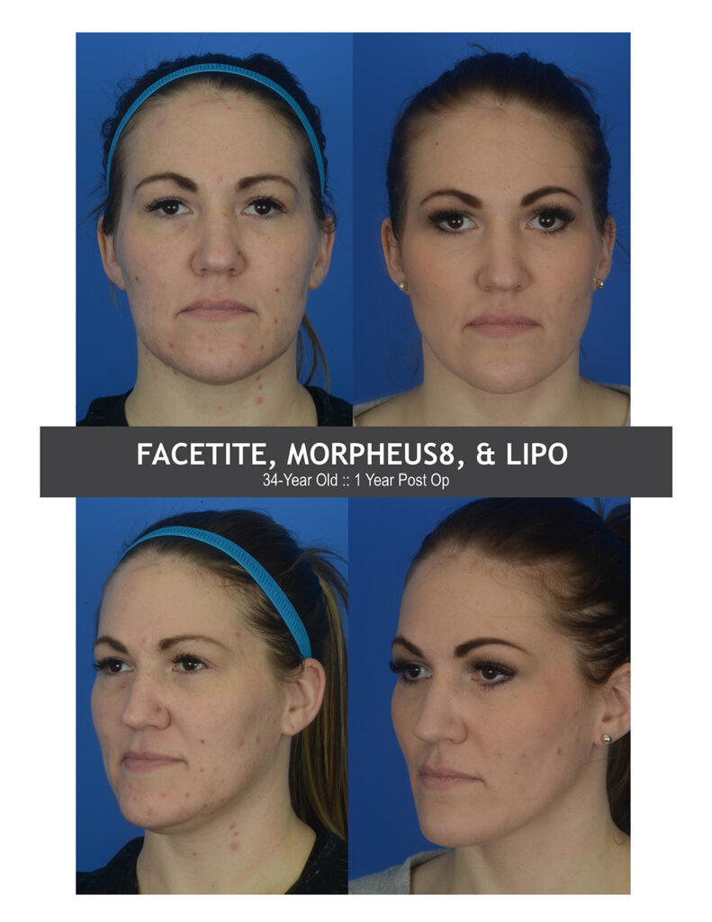 Facetite + Morpheus8 Before and After Photo by Dr. Caceres in St. Petersburg, FL
