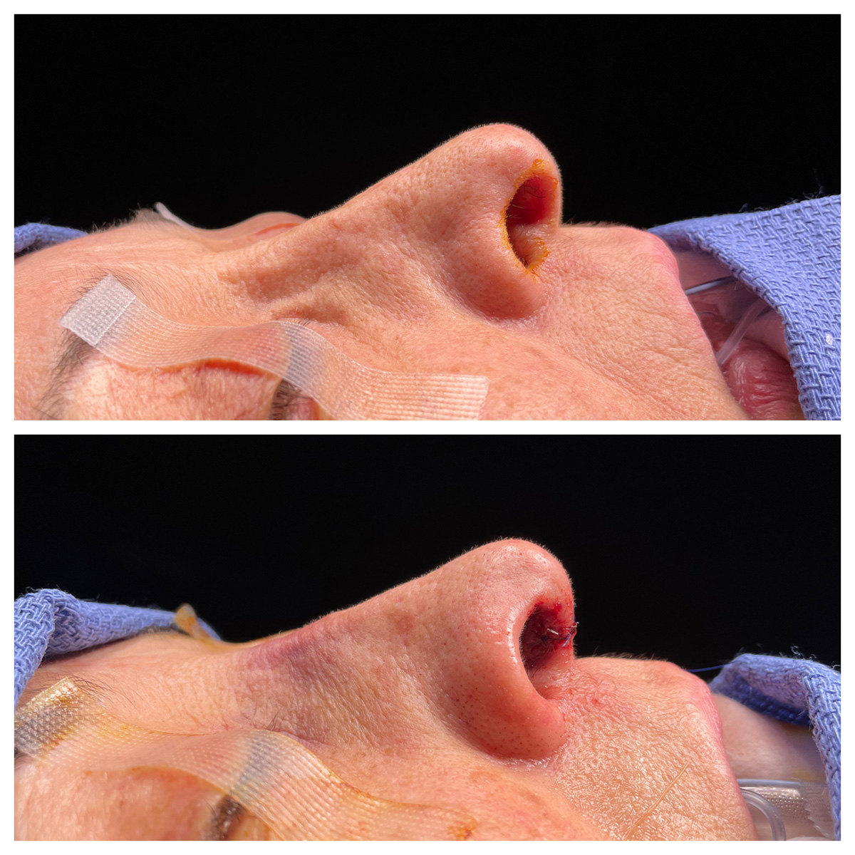 Revision Rhinoplasty Before and After Photo by Dr. Caceres in St. Petersburg, FL