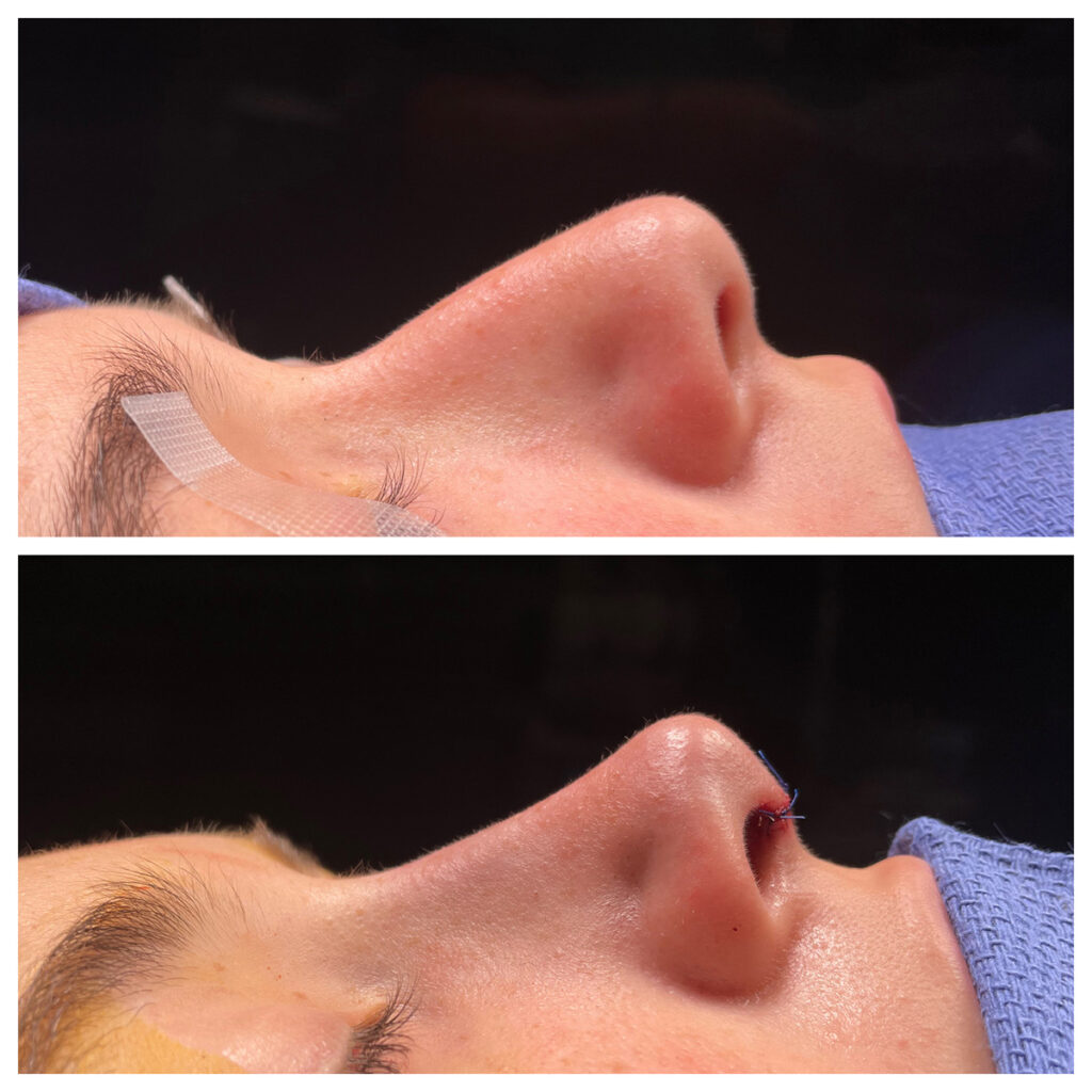 Revision Rhinoplasty Before and After Photo by Dr. Caceres in St. Petersburg, FL