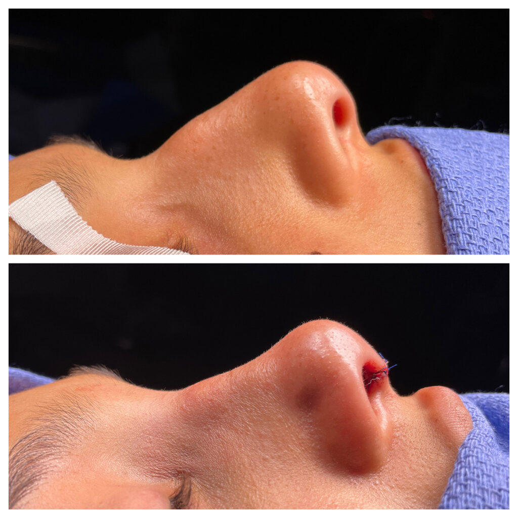 Rhinoplasty Before and After Photo by Dr. Caceres in St. Petersburg, FL