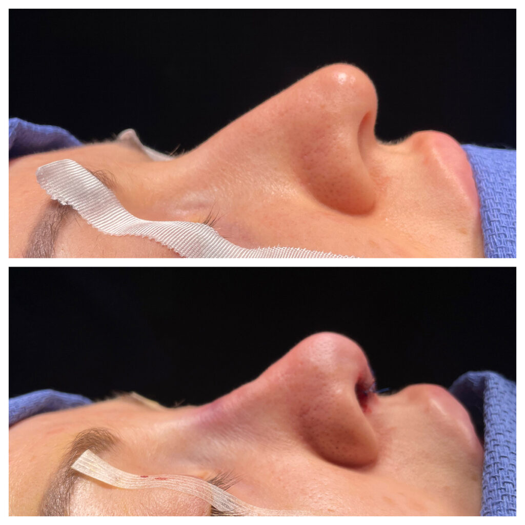 Rhinoplasty Before and After Photo by Dr. Caceres in St. Petersburg, FL