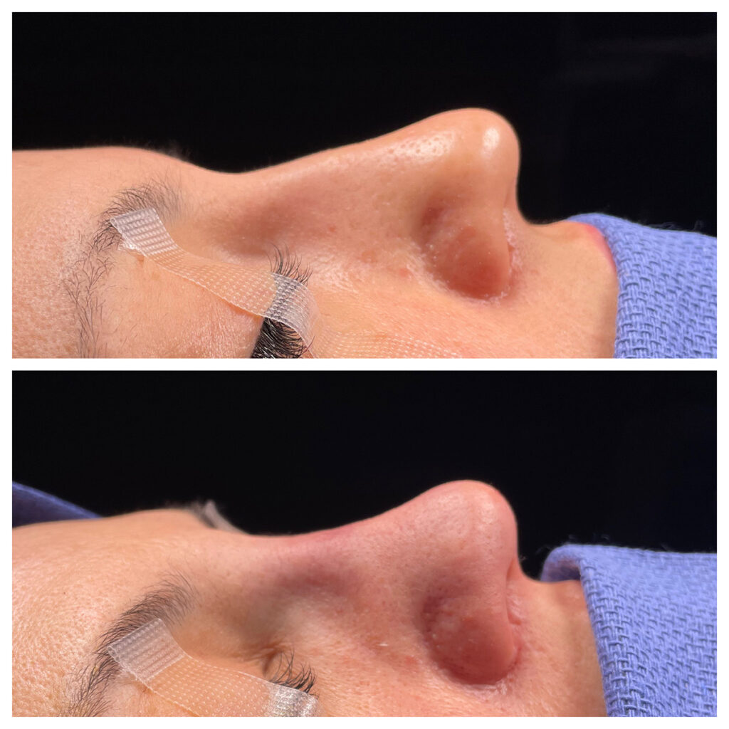 Rhinoplasty Before and After Photo by Dr. Caceres in St. Petersburg, FL