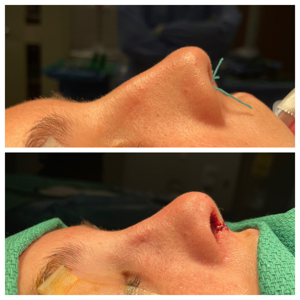 Rhinoplasty Before and After Photo by Dr. Caceres in St. Petersburg, FL