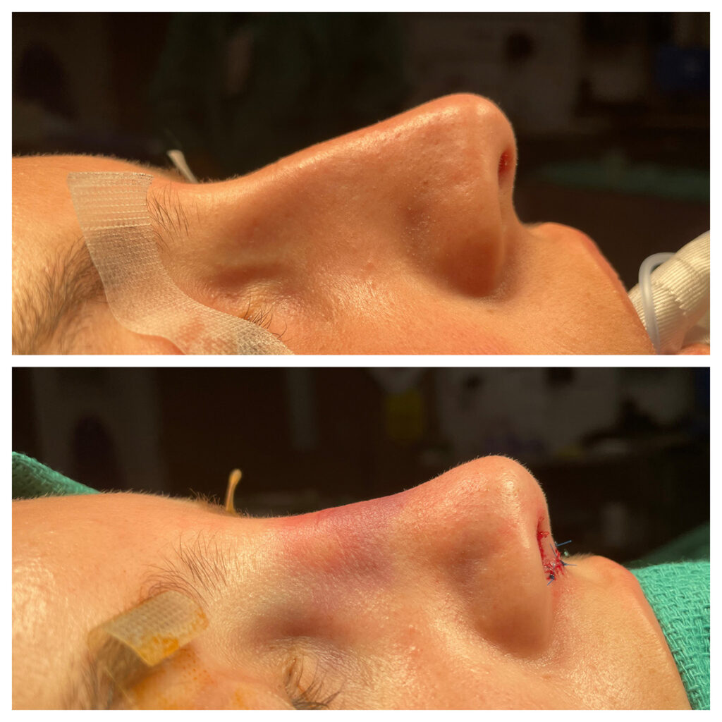 Rhinoplasty Before and After Photo by Dr. Caceres in St. Petersburg, FL