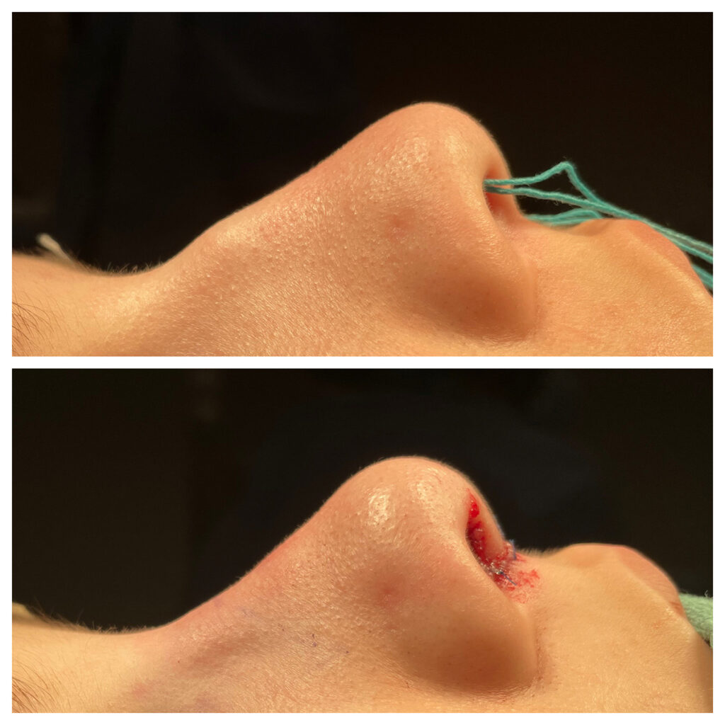 Rhinoplasty Before and After Photo by Dr. Caceres in St. Petersburg, FL