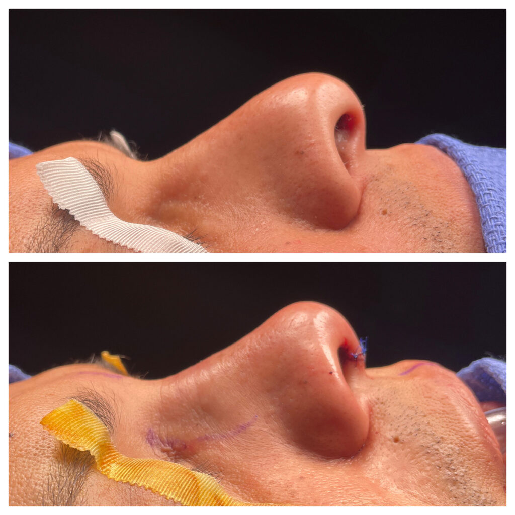 Rhinoplasty Before and After Photo by Dr. Caceres in St. Petersburg, FL