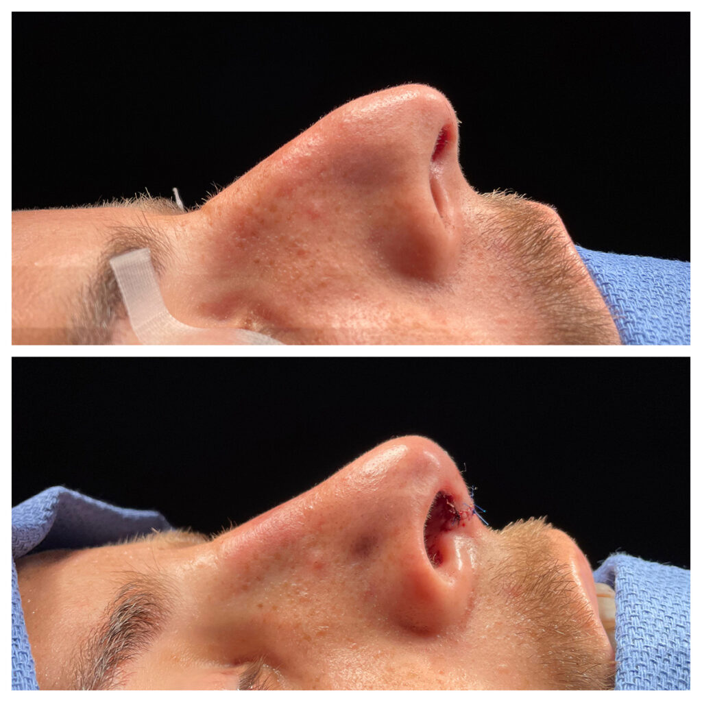 Rhinoplasty Before and After Photo by Dr. Caceres in St. Petersburg, FL