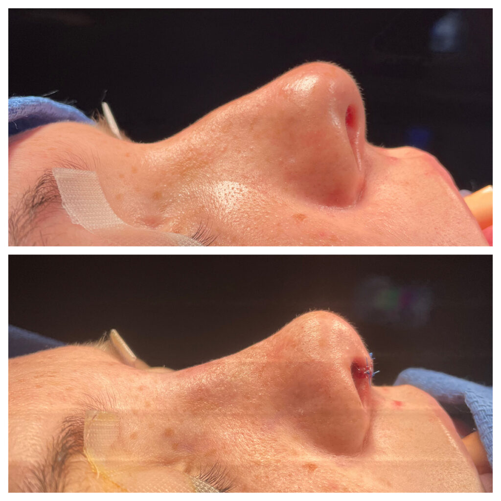 Rhinoplasty Before and After Photo by Dr. Caceres in St. Petersburg, FL