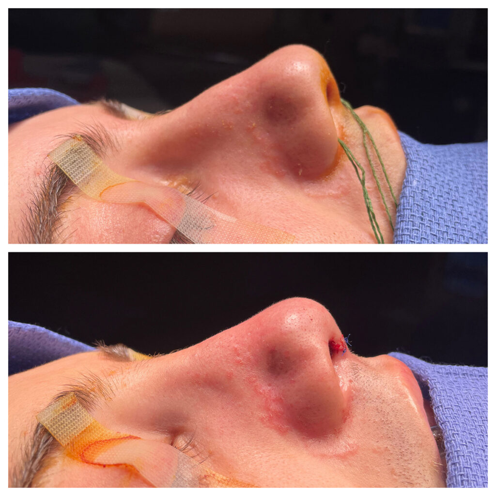 Rhinoplasty Before and After Photo by Dr. Caceres in St. Petersburg, FL