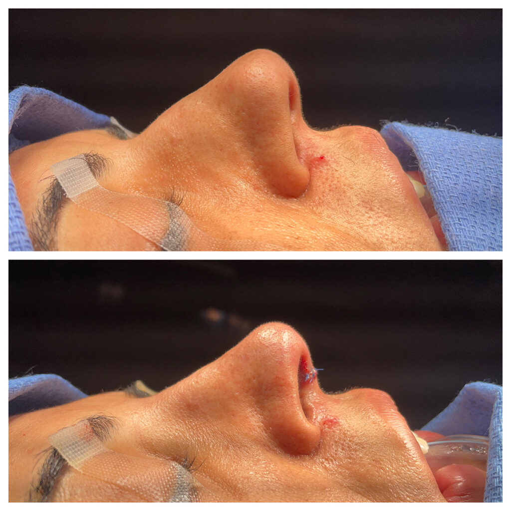 Rhinoplasty Before and After Photo by Dr. Caceres in St. Petersburg, FL