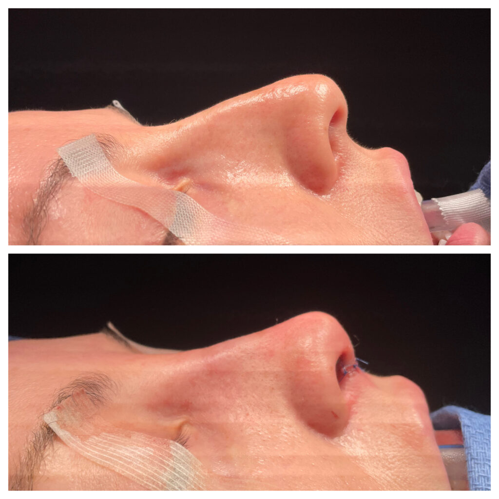 Rhinoplasty Before and After Photo by Dr. Caceres in St. Petersburg, FL