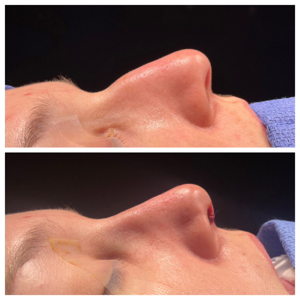 Rhinoplasty Before and After Photo by Dr. Caceres in St. Petersburg, FL