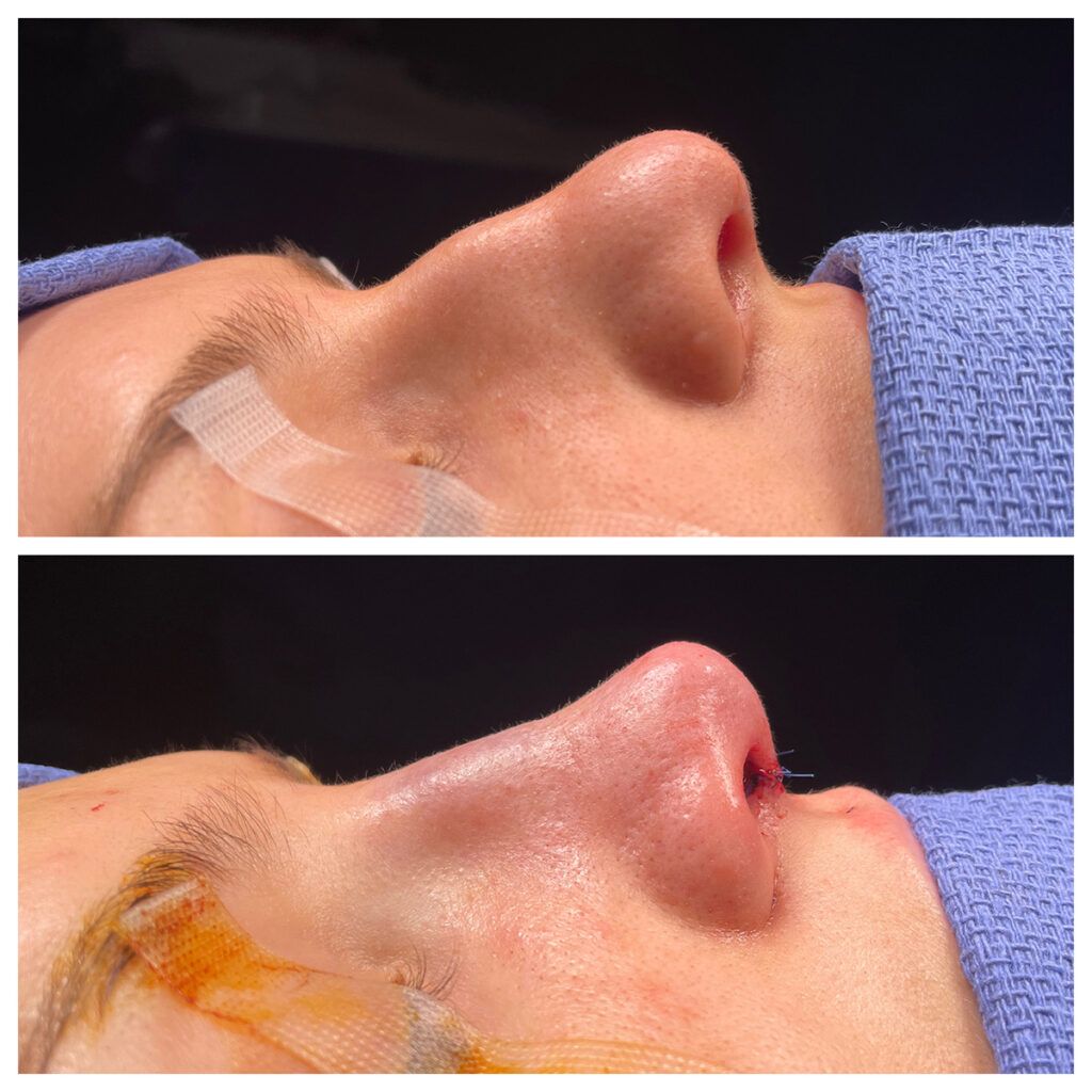 Rhinoplasty Before and After Photo by Dr. Caceres in St. Petersburg, FL