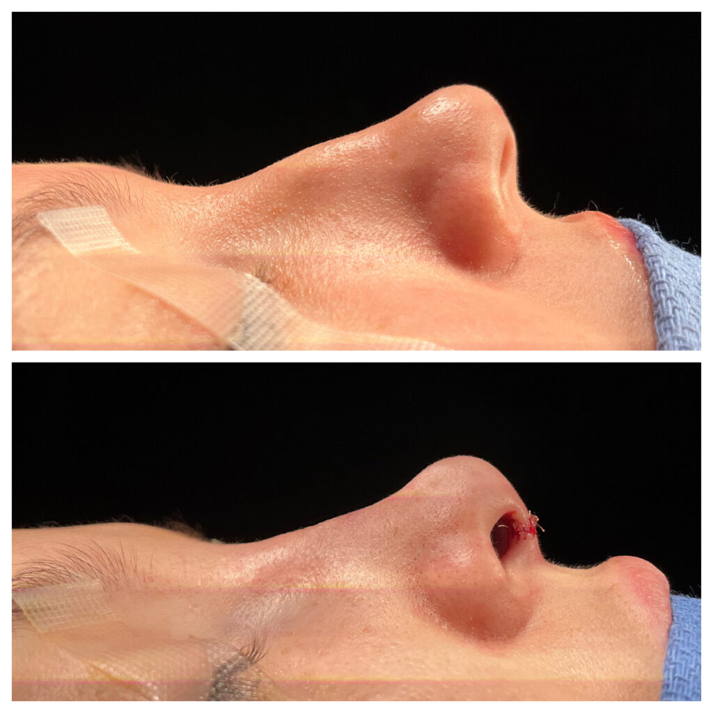 Rhinoplasty Before and After Photo by Dr. Caceres in St. Petersburg, FL