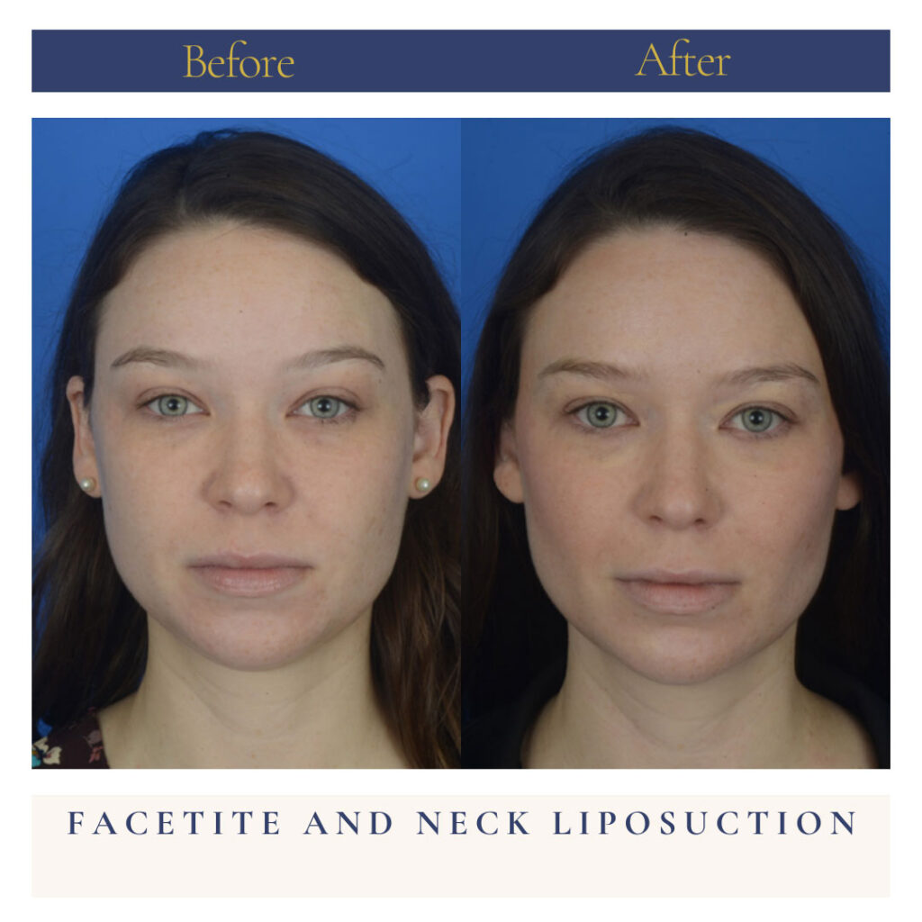 Facetite and Neck Liposuction Before and After Photo by Dr. Caceres in St. Petersburg, FL
