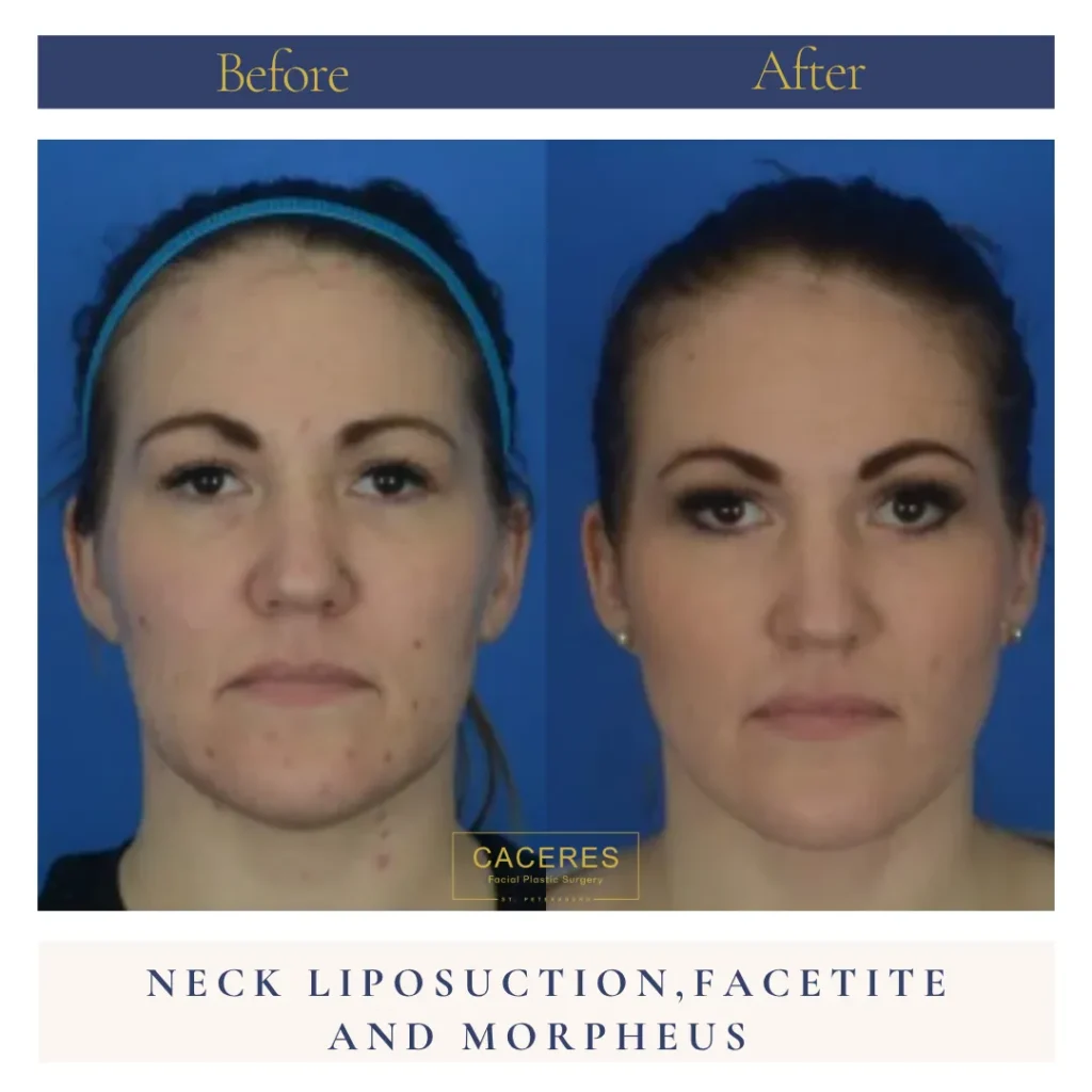 Front View Neck Lipo Facetite Morpheus Before and After Photo by Dr. Caceres