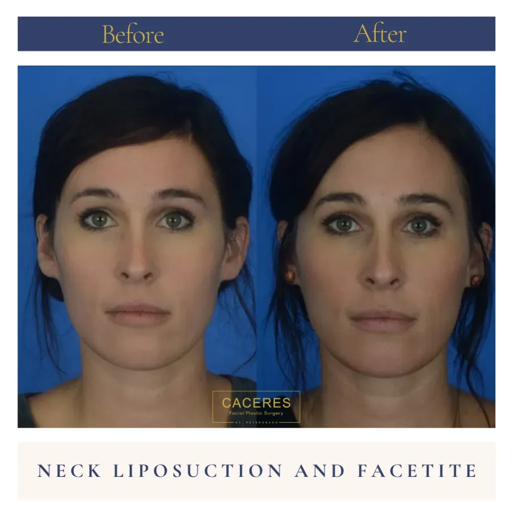 Front View Neck Lipo and Facetite Before and After Photo by Dr. Caceres