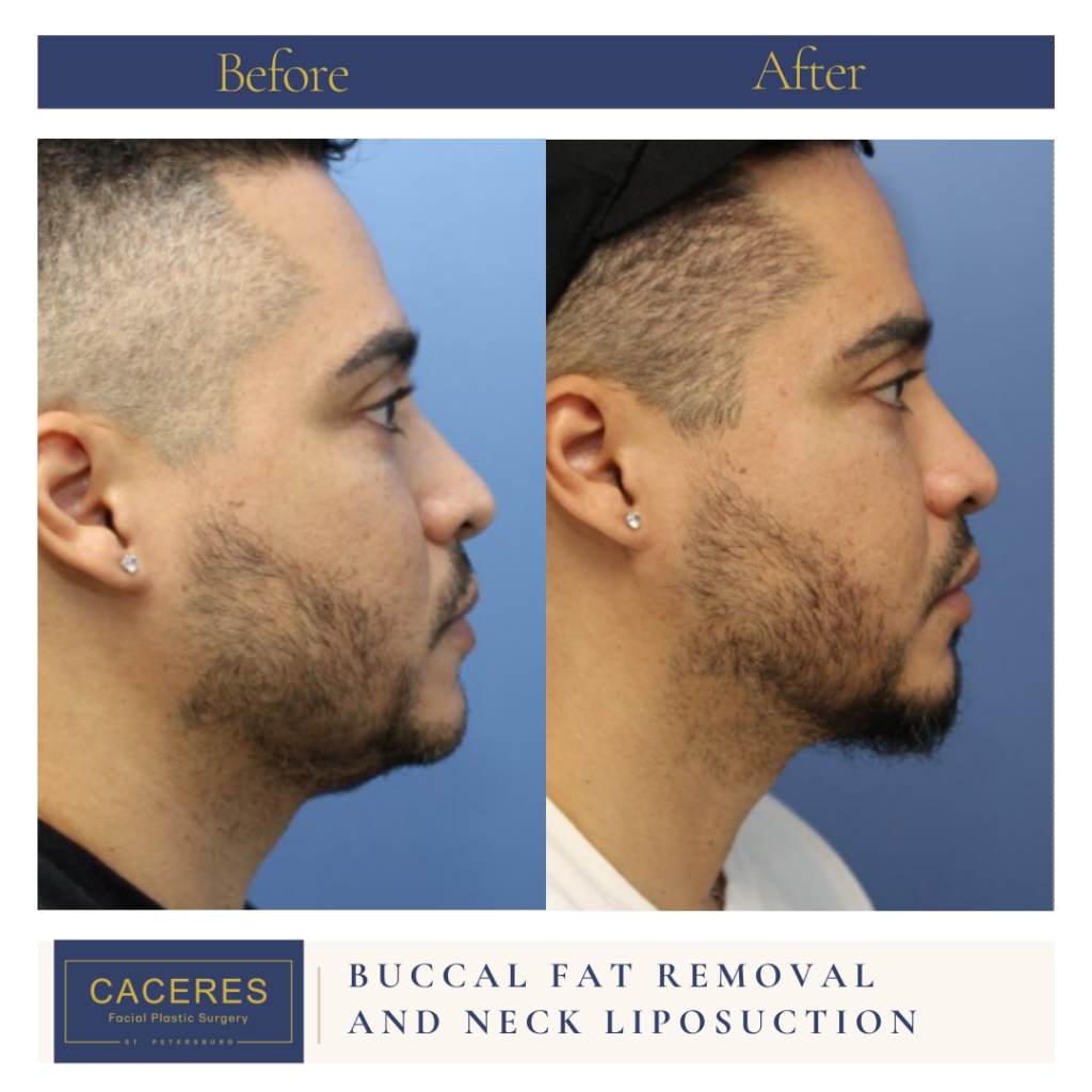 Buccal Fat Removal Before and After Photo by Dr. Caceres in St. Petersburg, FL