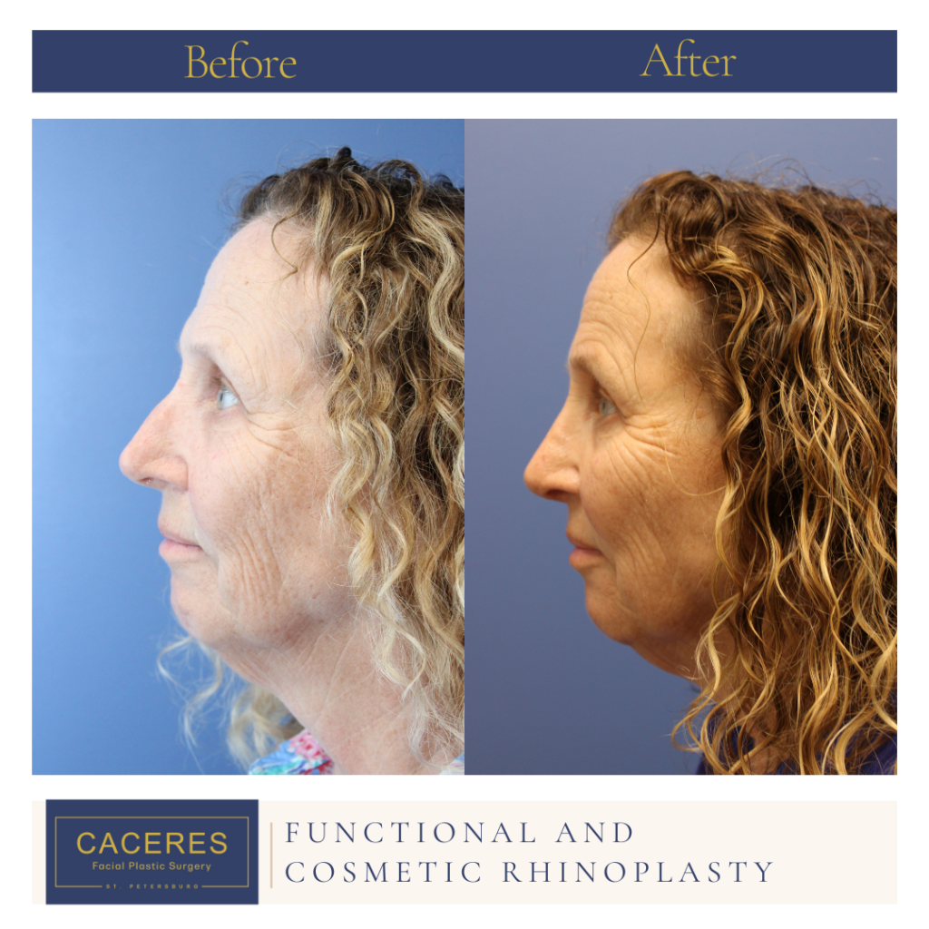 Female Rhinoplasty Before and After Photo by Dr. Caceres in St. Petersburg, FL