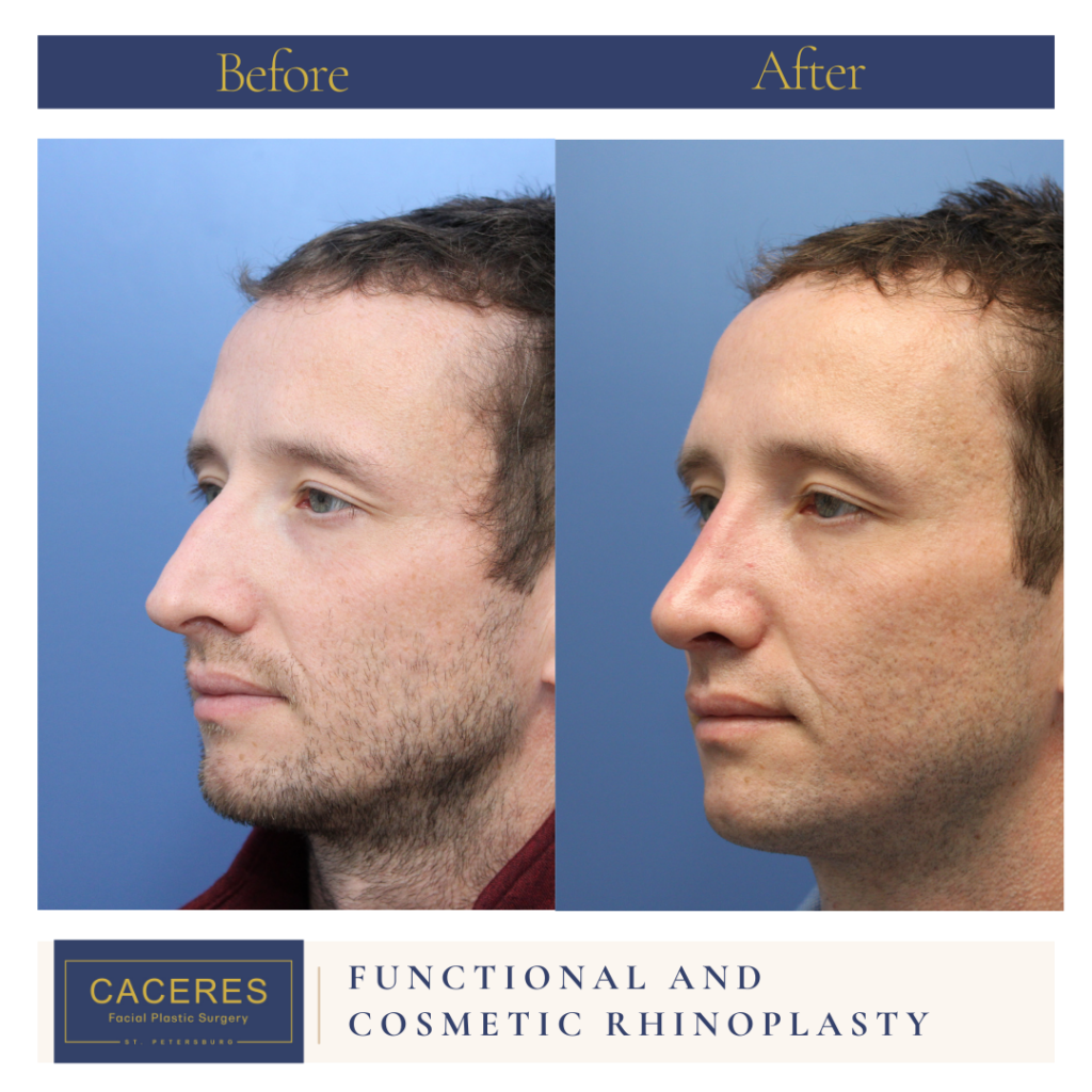 Male Rhinoplasty Before and After Photo by Dr. Caceres in St. Petersburg, FL