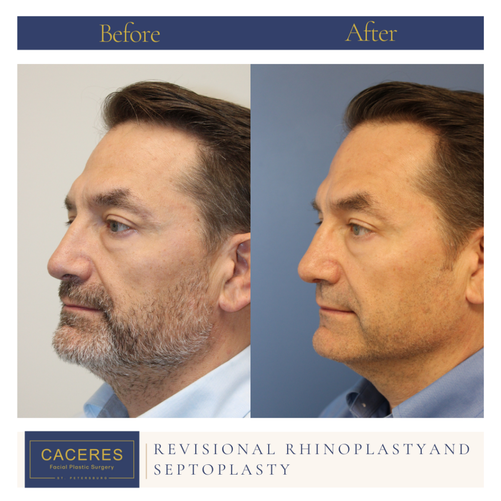 Male Rhinoplasty Before and After Photo by Dr. Caceres in St. Petersburg, FL