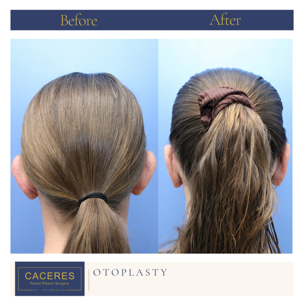 Otoplasty Before and After Photo by Dr. Caceres in St. Petersburg, FL