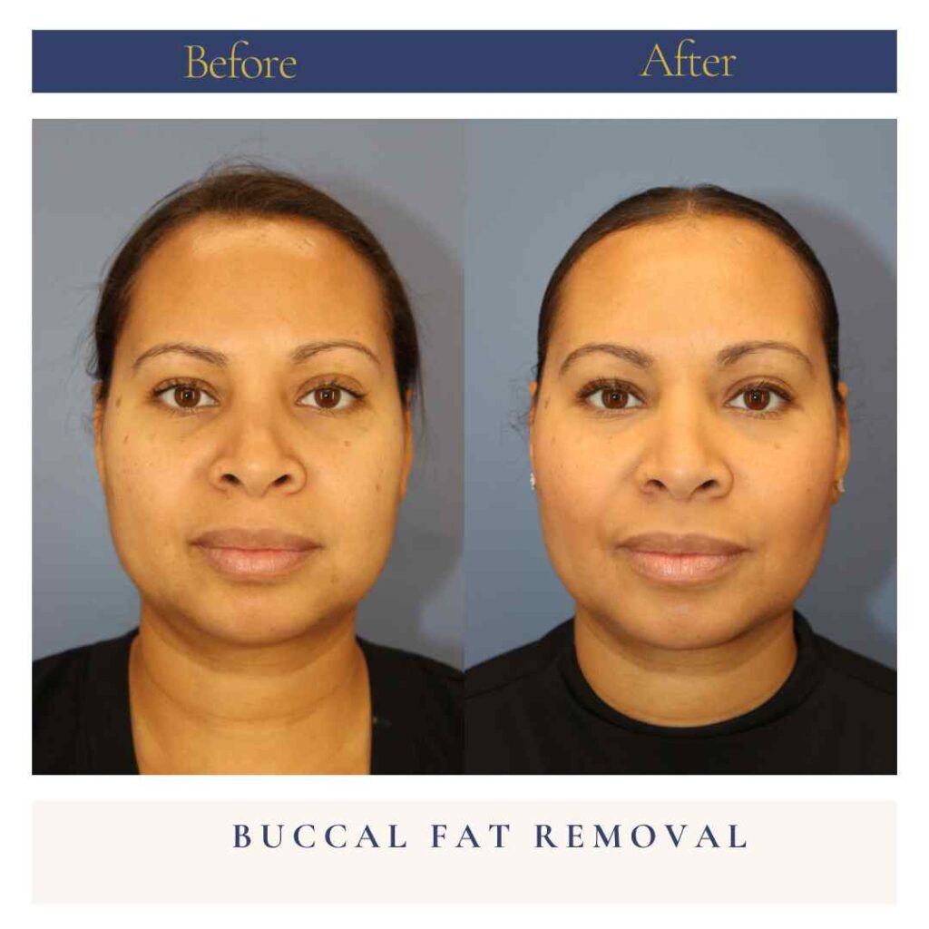Buccal Fat Removal Before and After Photo by Dr. Caceres in St. Petersburg, FL