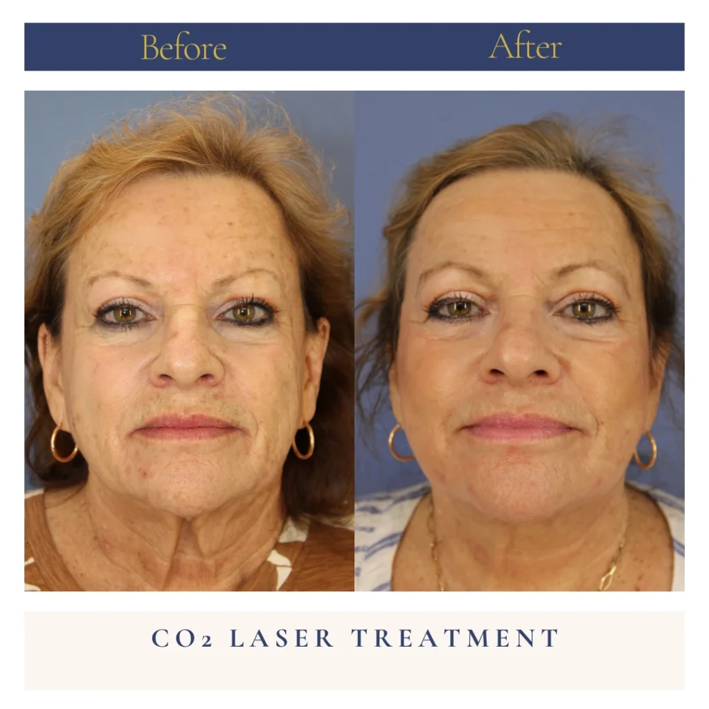 CO Laser Before and After Photo by Dr. Caceres in St. Petersburg Florida
