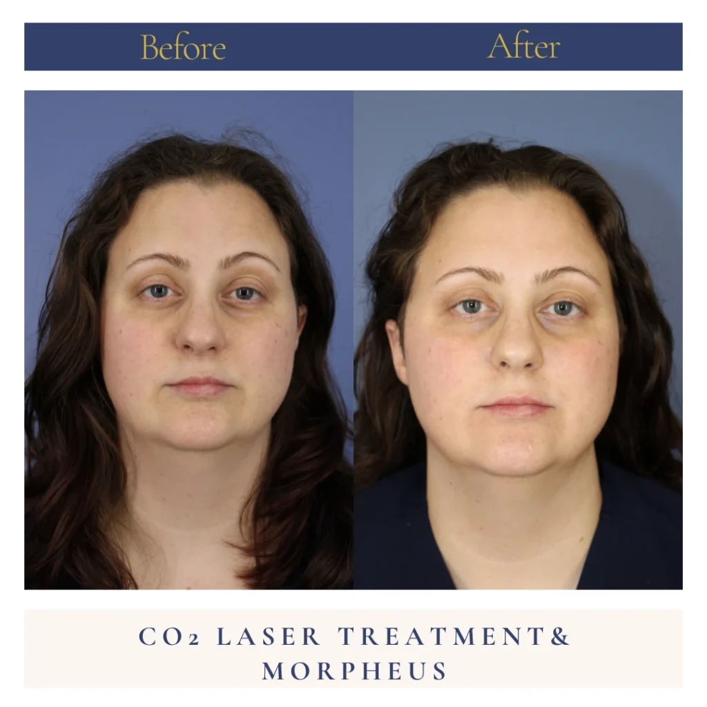 CO Laser and Morpheus Before and After Photo by Dr. Caceres in St. Petersburg Florida