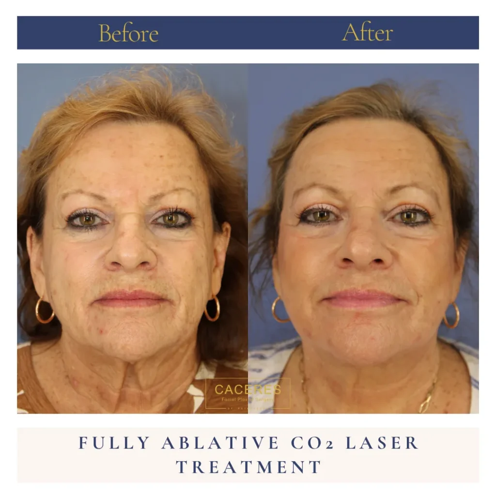 Front View CO Laser Before and After Photo by Dr. Caceres RC
