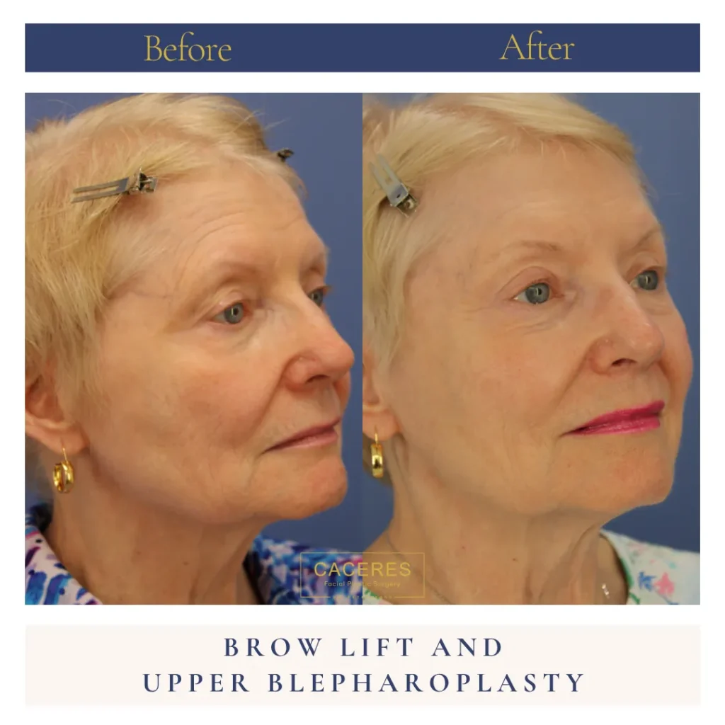 Oblique Right View Blepharoplasty Before and After Photo by Dr. Caceres NC