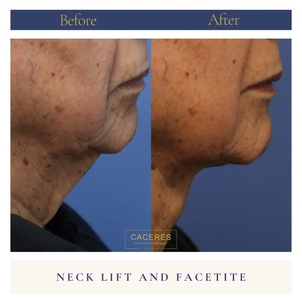 Right Side View Necklift and Facetite Before and After Photo by Dr. Caceres