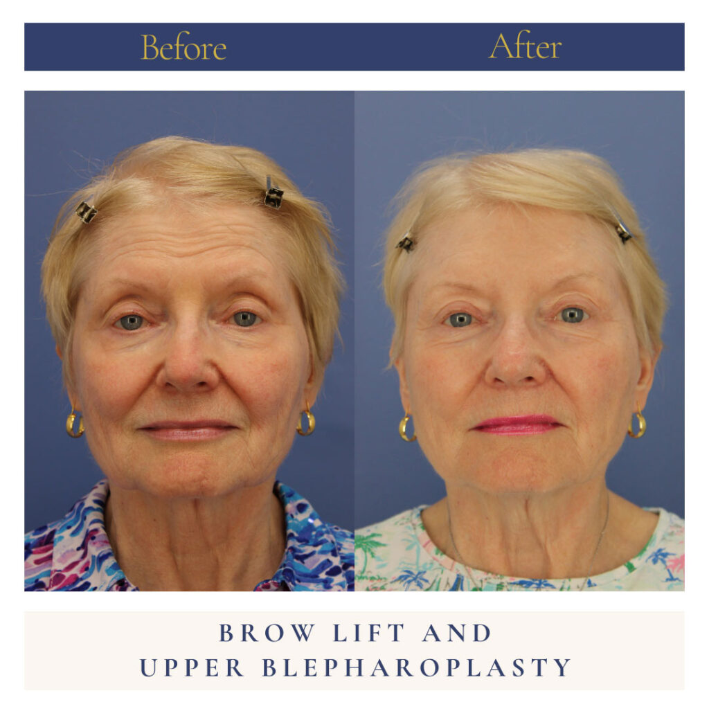 Upper Blepharoplasty Before and After Photo by Dr. Caceres in St. Petersburg, FL