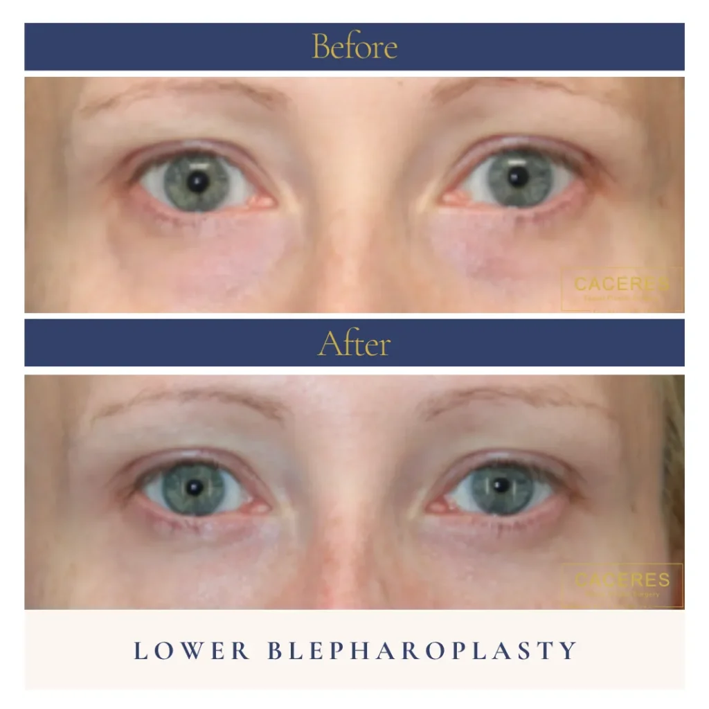 Close Up View Blepharoplasty Before and After Photo by Dr. Caceres