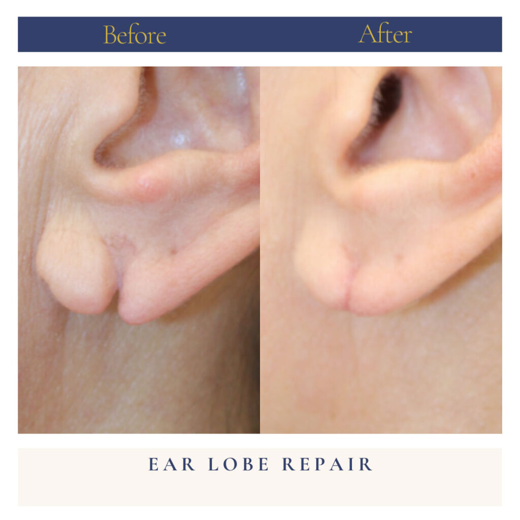 Ear Lobe Repair Before and After Photo by Dr. Caceres in St. Petersburg, FL