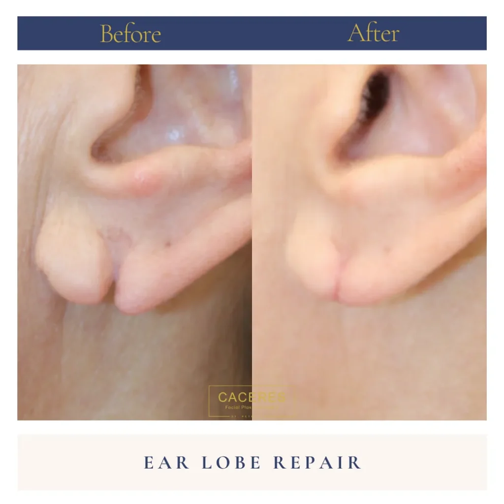 Left Side View Earlobe Repair Before and After Photo by Dr. Caceres AO