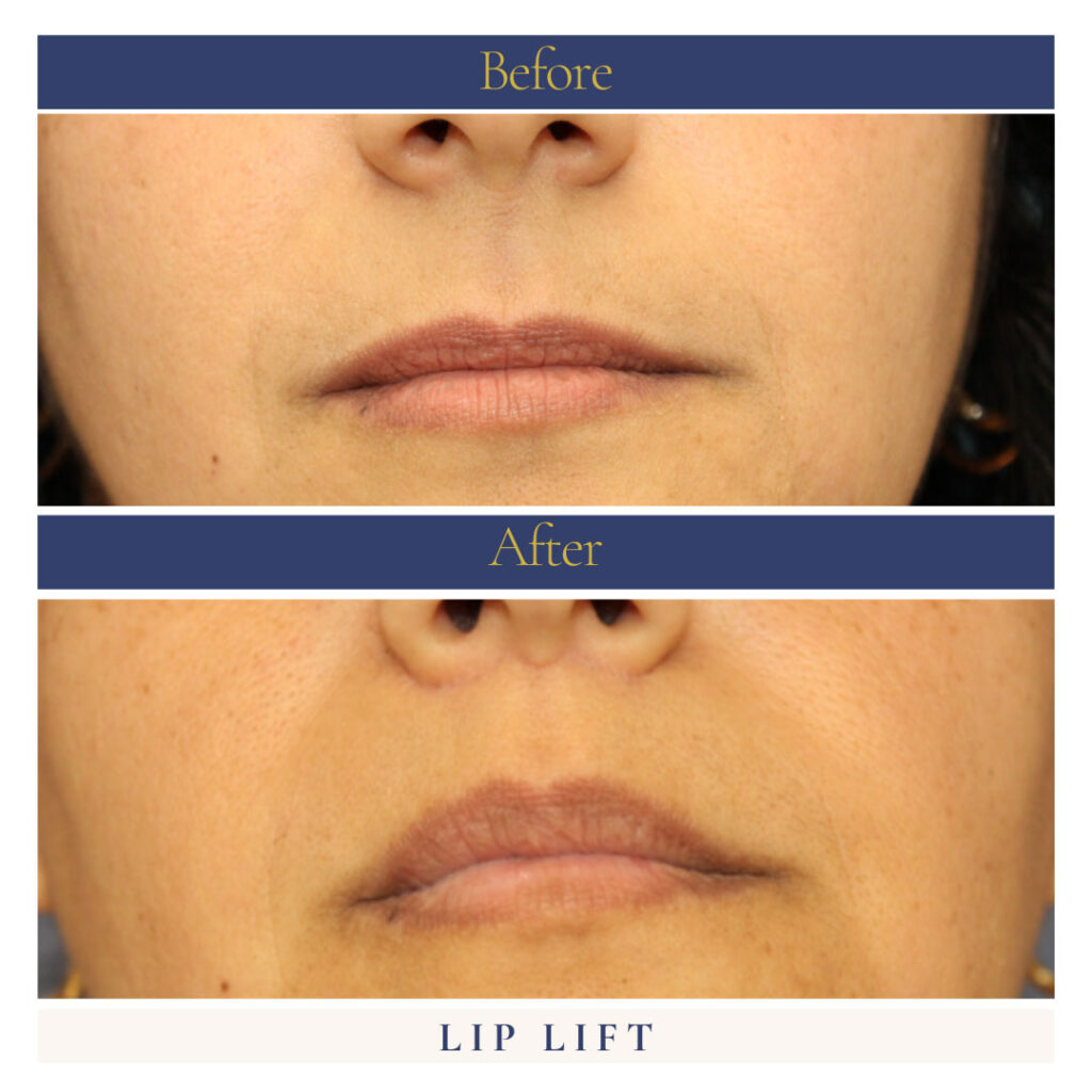 Lip Lift Before and After Photo by Dr. Caceres in St. Petersburg, FL