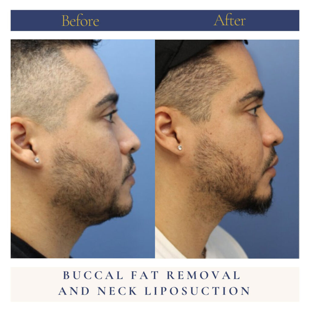 Neck Liposuction Before and After Photo by Dr. Caceres in St. Petersburg, FL