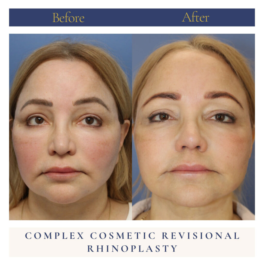 Revision Rhinoplasty Before and After Photo by Dr. Caceres in St. Petersburg, FL