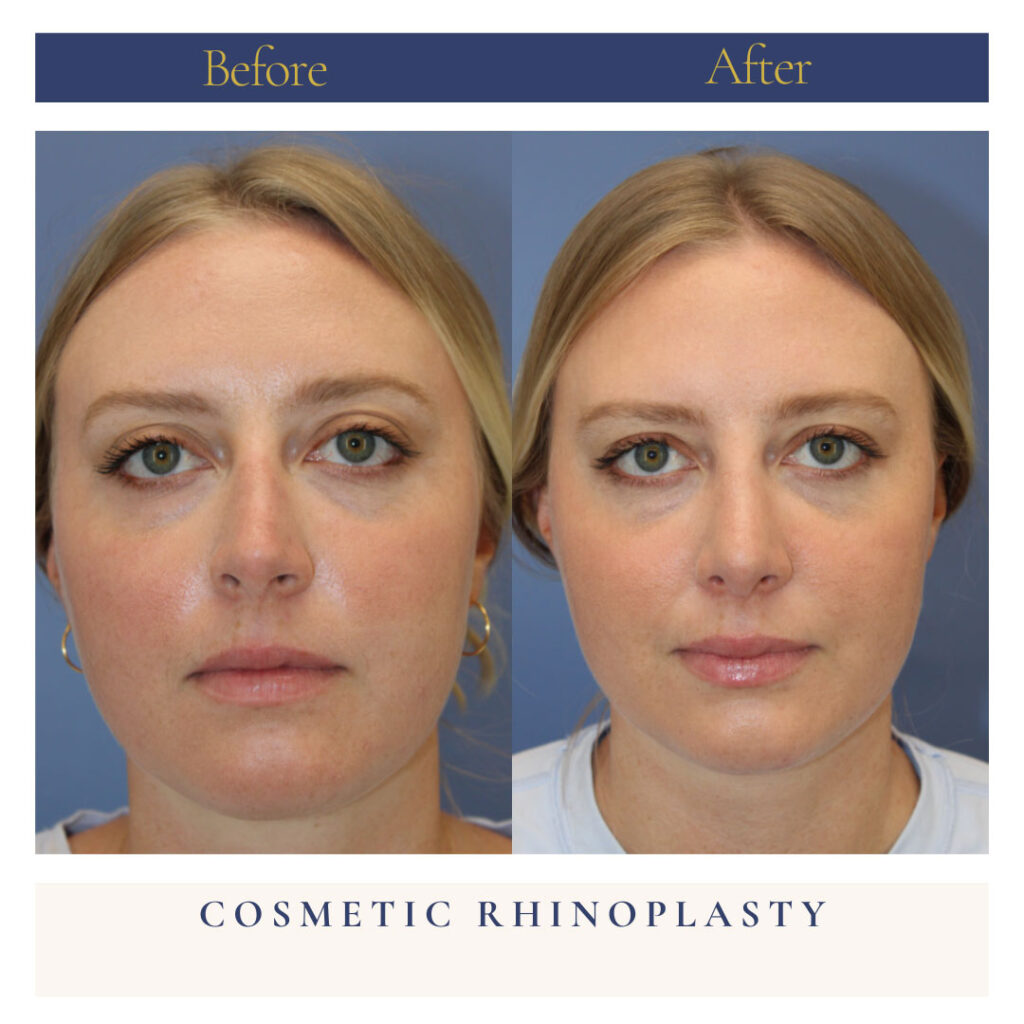 Rhinoplasty Before and After Photo by Dr. Caceres in St. Petersburg, FL