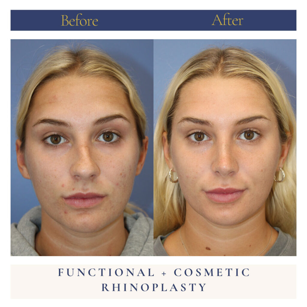 Rhinoplasty Before and After Photo by Dr. Caceres in St. Petersburg, FL