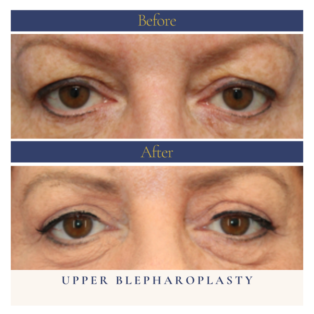Upper bleph