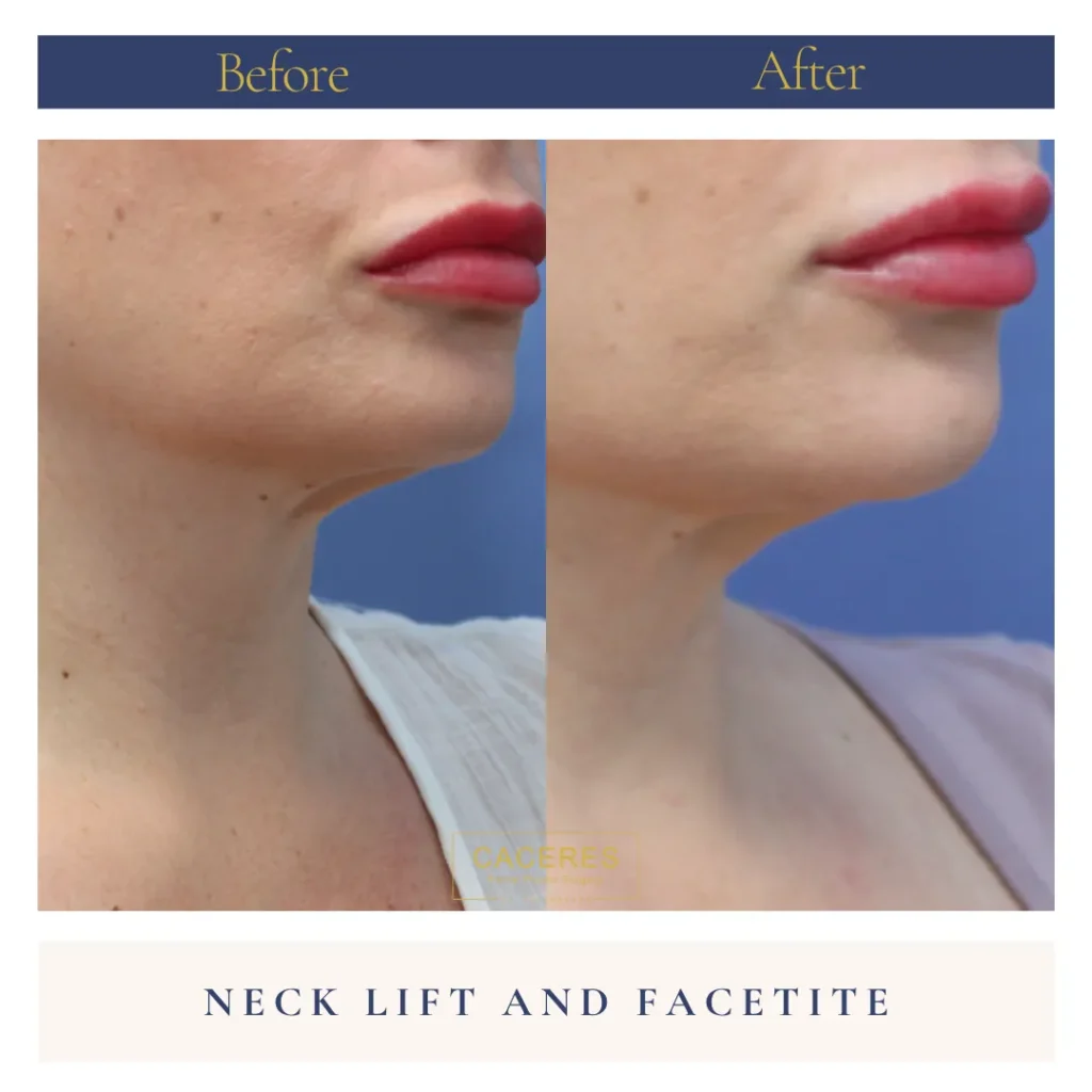 Right Oblique View Necklift and Facetite Before and After Photo by Dr. Caceres