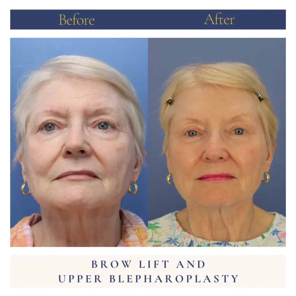 Front View Blepharoplasty Before and After Photo by Dr. Caceres