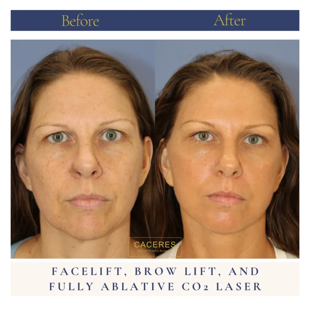 Front View Brow Lift Before and After Photo by Dr. Caceres