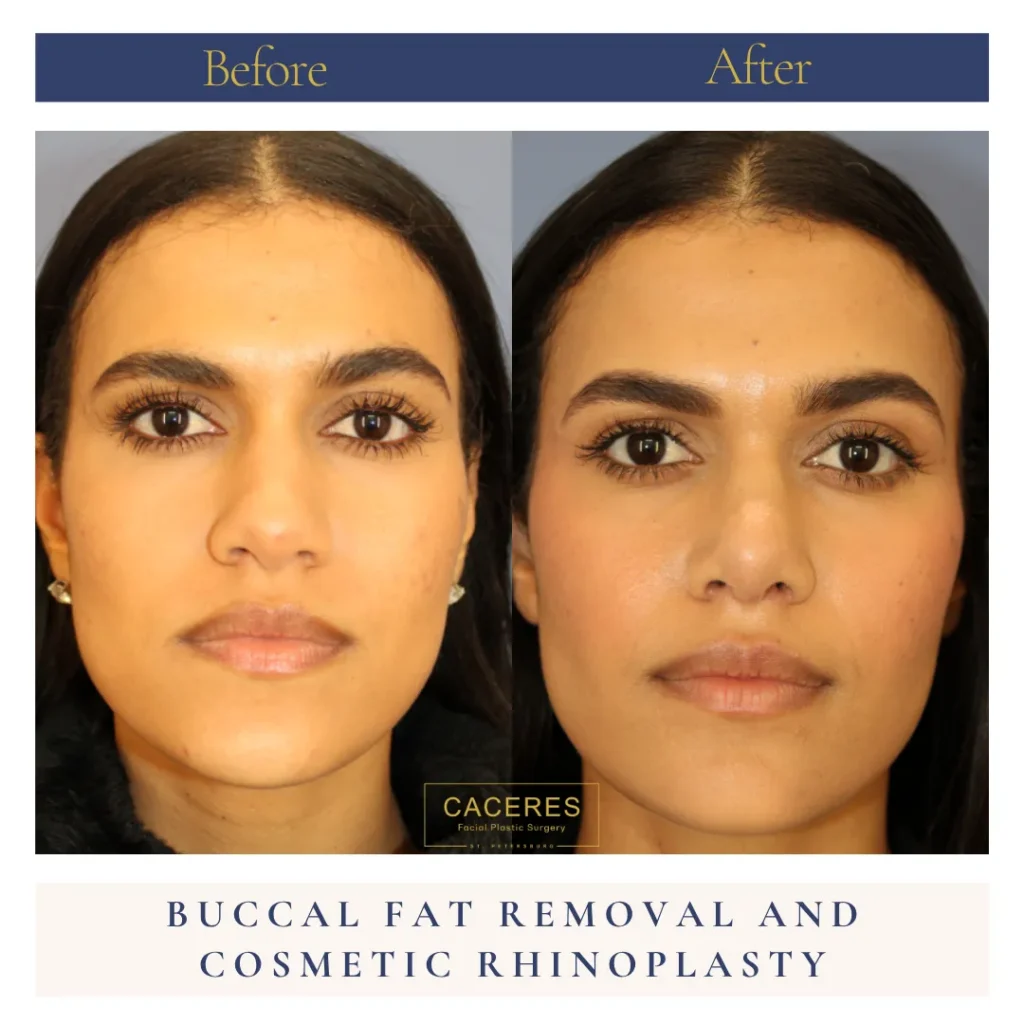 Front View Buccal Fat Removal Before and After Photo by Dr. Caceres LP