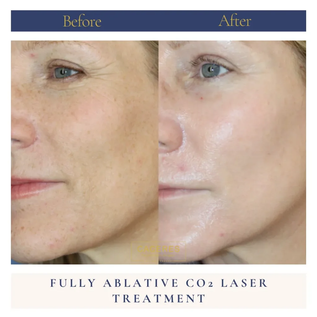 Left Oblique View CO Laser Treatment Before and After Photo by Dr. Caceres MB