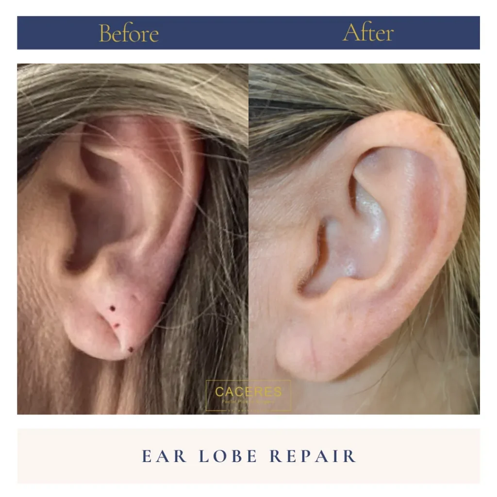 Left Side View Earlobe Repair Before and After Photo by Dr. Caceres CP