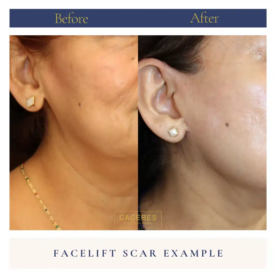 Right Oblique View Facelift Before and After Photo by Dr. Caceres Right Oblique View Facelift Before and After Photo by Dr. Caceres